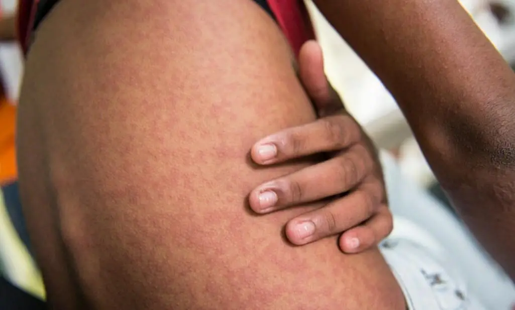 Chikungunya Virüsü: Bulaşıcı mı, Tehlikeli mi? DSÖ’den Uyarı Geldi!