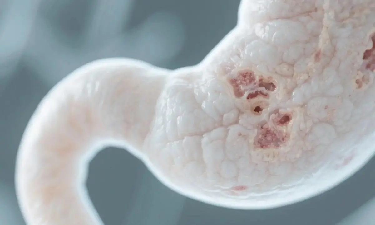 Atrofik Gastrit Nedir? Belirtileri ve Tedavi Yöntemleri