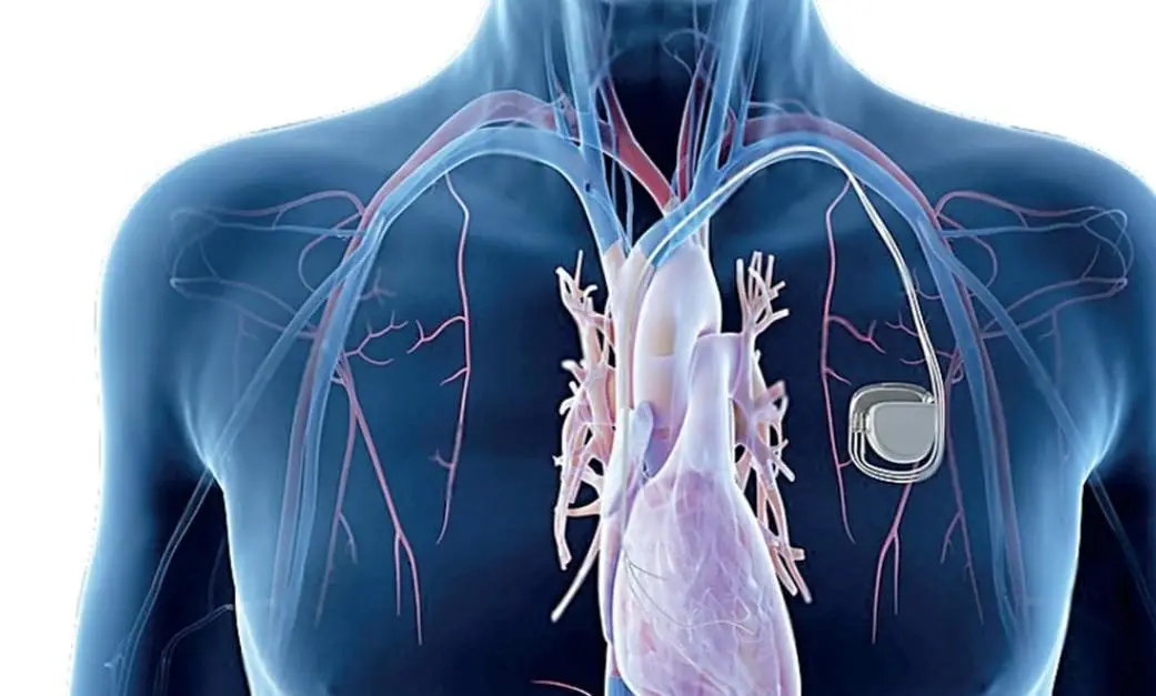 Kalp Pili, Stent ve Bypass: Hangi Durumda Hangisi Uygulanır?